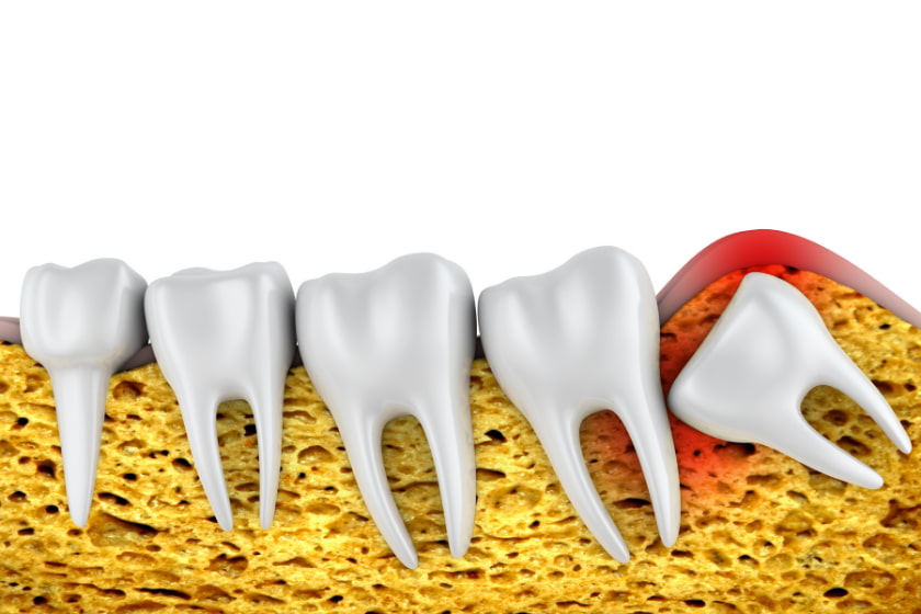 how to prepare for wisdom tooth removal