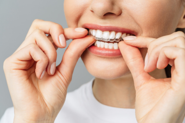 should you choose orthodontic treatment or dental veneers