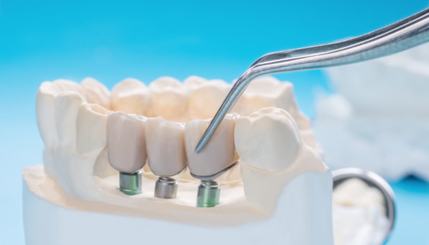 Dental Implants vs Dental Bridges