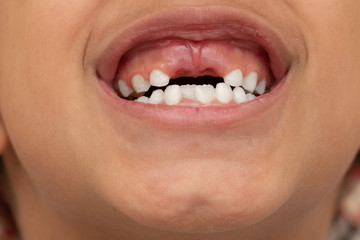 signs your child might require orthodontic treatment