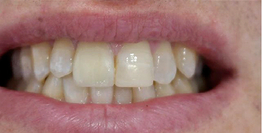 veneers restoration of a broken anterior tooth 01