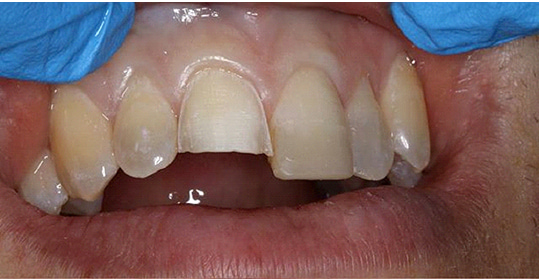 veneers restoration of a broken anterior tooth
