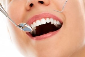 what dental cleaning involve