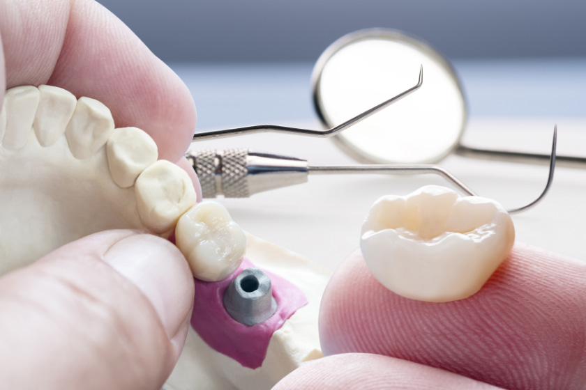 what should i know before dental implants