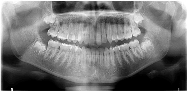 wisdom teeth and late crowding dr tosun dental clinic