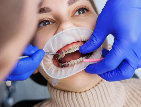 Orthodontic Treatment